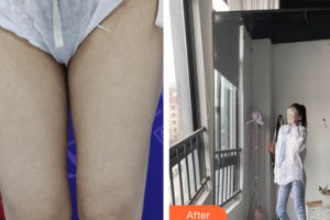 東莞瑞芙臣醫(yī)療美容門診部吳枓映整形價格表附大腿腰腹環(huán)吸案例展示