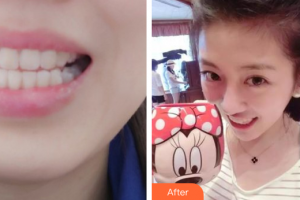 東莞華美醫(yī)療美容醫(yī)院熊科明整形價(jià)格表附隱形矯正案例展示