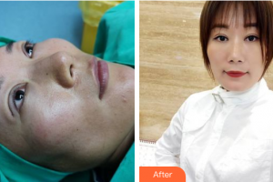 東莞百佳瑪麗亞婦產(chǎn)醫(yī)院陳銘整形價(jià)格表附雙眼皮案例展示