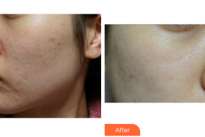 東莞寶格麗醫(yī)療美容門診部唐可可整形價(jià)格表附清潔祛痘案例展示