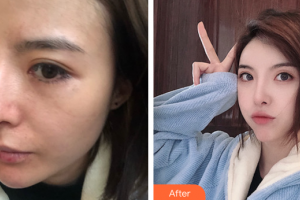 東莞寶格麗醫(yī)療美容門診部吳波整形價(jià)格表附埋線提升案例展示