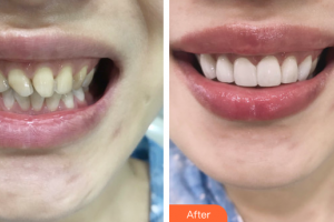 東莞美立方美容醫(yī)院肖連永整形價(jià)格表附牙齒貼片案例展示