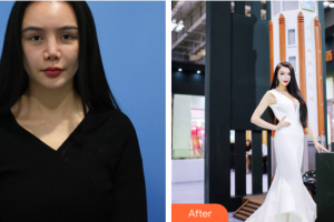 東莞市第六人民醫(yī)院醫(yī)療美容中心彭曉云整形價(jià)格表附自體脂肪隆胸案例展示