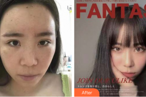 東莞美立方美容醫(yī)院張克整形價(jià)格表附切開重瞼+內(nèi)眥贅皮矯正案例展示