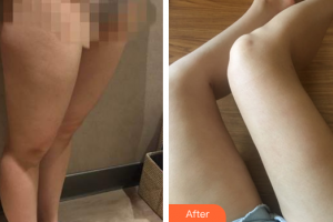 東莞同濟(jì)光華醫(yī)院口腔科郭愛華整形價(jià)格表附大腿吸脂案例展示