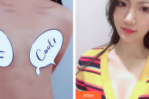 東莞非凡美容醫(yī)院易培金整形價(jià)格表附假體隆胸案例展示