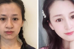 武漢明星醫(yī)學(xué)整形美容醫(yī)院李欣融整形價格表附激光祛斑案例展示