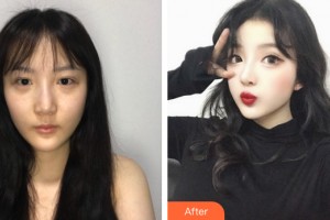 河南整形美容醫(yī)院支凌翔整形價格表附隆鼻手術(shù)案例展示