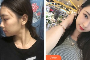 河南大學(xué)附屬南石醫(yī)院燒傷整形美容中心趙俊祥整形價格表附皮膚美容案例展示