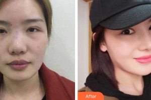 河南大學(xué)附屬南石醫(yī)院燒傷整形美容中心楊丙厚整形價(jià)格表附隆鼻手術(shù)案例展示