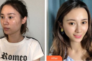 河南大學(xué)附屬南石醫(yī)院燒傷整形美容中心趙俊芳整形價(jià)格表附皮膚美容案例展示