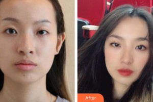 河南省現(xiàn)代醫(yī)學(xué)研究院中醫(yī)院七星整形美容中心劉鵬整形價(jià)格表附植發(fā)案例展示