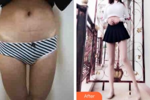 河南科技大學(xué)第一附屬醫(yī)院整形美容科徐興軍整形價(jià)格表附大腿吸脂案例展示