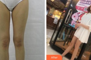 河南整形美容醫(yī)院白玉龍整形價(jià)格表附大腿吸脂案例展示