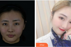 河南大學(xué)第一附屬醫(yī)院醫(yī)療美容科陳春瑞整形價格表附皮膚美容案例展示