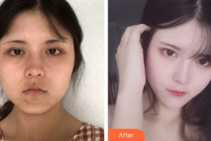 河南整形美容醫(yī)院楊萬忠整形價格表附皮膚美容案例展示