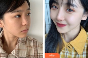 河南中醫(yī)藥大學(xué)第一附屬醫(yī)院整形美容科葛艷娜整形價格表附隆鼻手術(shù)案例展示