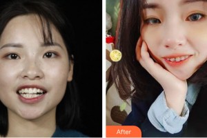 海南泰康拜博口腔醫(yī)院肖麗整形價格表附牙齒矯正案例展示