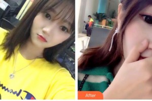 湖北恩施咿呀牙科診所晏峰主任醫(yī)師整形價格表附超聲波潔牙案例展示