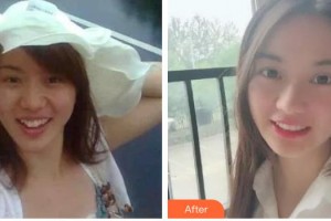 廣東藥科大學(xué)附屬第三醫(yī)院整形美容科黃羨整形價格表附金屬托槽矯正案例展示