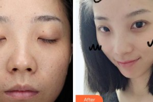 廣東藥科大學(xué)附屬第三醫(yī)院整形美容科巫尾英整形價格表附激光點痣案例展示