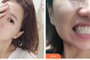 廣東藥科大學(xué)附屬第三醫(yī)院整形美容科安宇寧整形價(jià)格表附牙齒陶瓷矯正案例展示