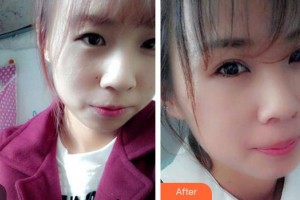 廣東省婦幼保健院整形美容中心胡葵葵整形價(jià)格表附牙貼面案例展示