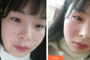 武警廣東總隊(duì)醫(yī)院整形美容中心朱彤玥整形價(jià)格表附激光點(diǎn)痣案例展示