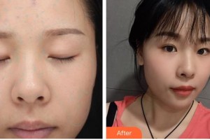 武警廣東總隊(duì)醫(yī)院整形美容中心趙新央整形價(jià)格表附光子嫩膚案例展示