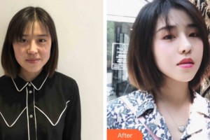 海南整形美容醫(yī)院楊洪波整形價(jià)格表附皮膚美容案例展示