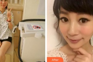 云南華美美萊美容醫(yī)院Lemperle(藍(lán)博)整形價(jià)格表附鐳射凈膚案例展示