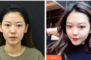 云南華美美萊美容醫(yī)院余龍整形價(jià)格表附光子嫩膚案例展示