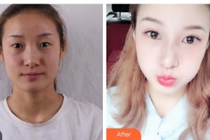 云南瑪麗亞整形美容醫(yī)院陳志棟整形價(jià)格表附切開雙眼皮案例展示