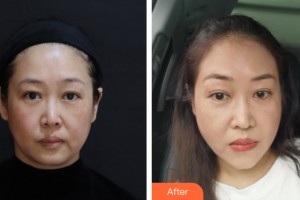 海南夢妮幻整形?？崎T診部劉天頂整形價(jià)格表附皮膚美容案例展示