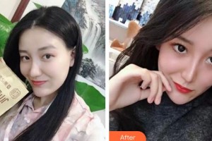 云南華美美萊美容醫(yī)院黃夢(mèng)婷整形價(jià)格表附清潔祛痘案例展示