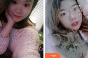 云南華美美萊美容醫(yī)院劉乙辰整形價格表附牙齒隱形矯正案例展示