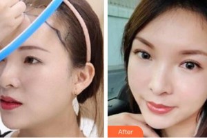 武警云南省邊防總隊醫(yī)院整形美容中心尹煒能整形價格表附種植發(fā)際線案例展示