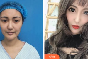 海南省皮膚病醫(yī)院激光整形美容中心翟培明整形價(jià)格表附眼部手術(shù)案例展示