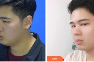 云南銅雀臺整形美容醫(yī)院李信奎院長整形價格表附減脂案例展示