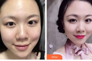 云南華美美萊美容醫(yī)院楊光整形價格表附祛斑祛痣案例展示