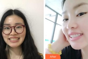 海南鼎點(diǎn)口腔醫(yī)院張思如整形價(jià)格表附牙齒矯正案例展示