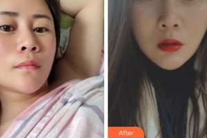 云南省第一人民醫(yī)院眼科楊崢嶸整形價(jià)格表附水氧活膚案例展示