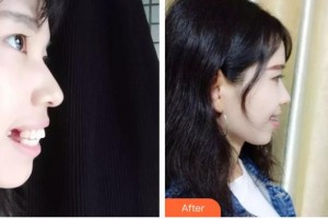 云南竹子口腔醫(yī)院趙志平整形價格表附隱形托槽矯正案例展示