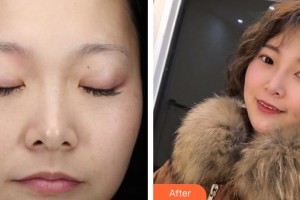 云南銅雀臺(tái)整形美容醫(yī)院楊云東院長(zhǎng)整形價(jià)格表附激光祛斑】案例展示