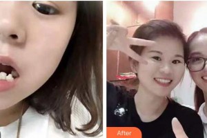 云南德普口腔醫(yī)院王霞整形價(jià)格表附牙齒陶瓷矯正案例展示