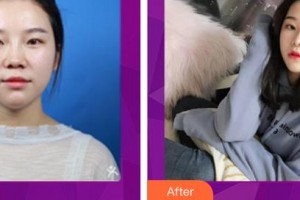 昆明夢想醫(yī)療美容醫(yī)院胡凱整形價格表附耳軟骨復合隆鼻案例展示