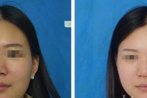 昆明醫(yī)學(xué)院整形美容中心焦圓華整形價格表附激光祛斑案例展示