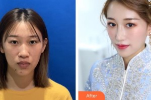 昆明楊穗醫(yī)療美容診所楊穗整形價格表附膨體隆鼻案例展示