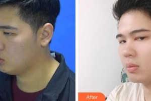 昆明醫(yī)學院第二附屬醫(yī)院燒傷整形科付晉鳳整形價格表附減脂案例展示