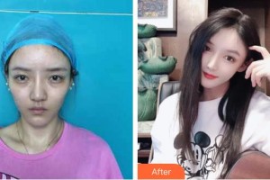 昆明麗都醫(yī)療美容醫(yī)院李喜永整形價格表附假體墊眉弓案例展示